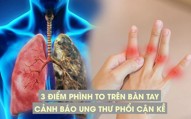 3 điểm phình to trên bàn tay cảnh báo phổi đang bị tấn công: Tín hiệu báo trước ung thư phổi cận kề nhưng nhiều người lại tưởng bệnh vặt